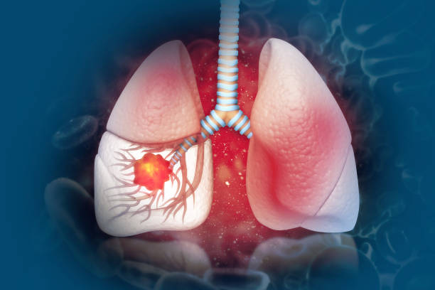 Người hút thuốc lá thụ động có nguy cơ cao mắc ung thư phổi